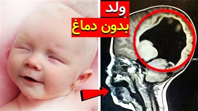 الطفل المعجزة.. ولد بدون دماغ وقال الاطباء انه لن يعيش , ولكن بعد 3 سنوات صدم العلماء