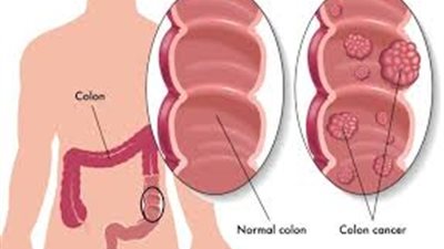 سړطان القولون أسبابه وطرق التعرف عليه وطرق علاجه والوقايه منه